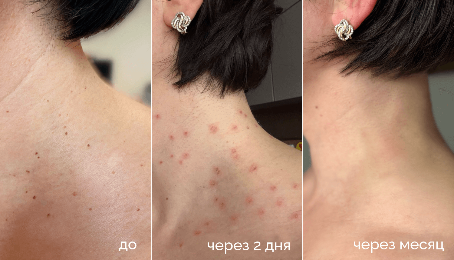 удаление папиллом лазером