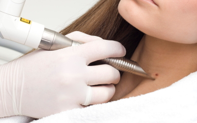 Почему лазер — один из самых точных методов удаления папиллом?