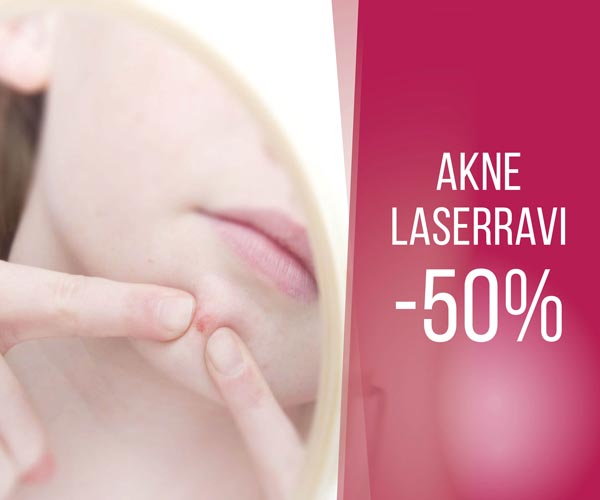 Seda sa ei ole veel proovinud! Akne laserravi -50%!