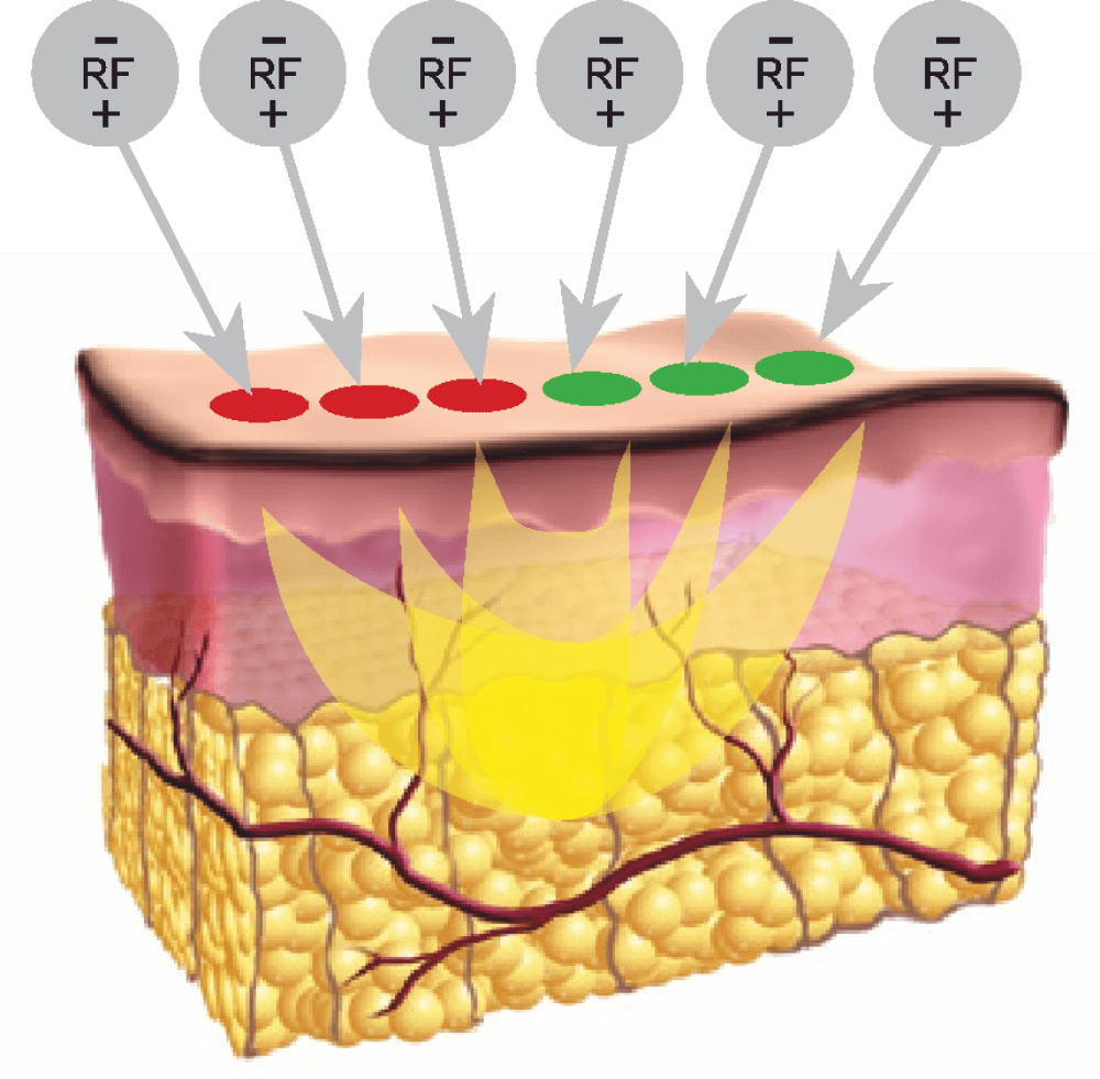 RF noorendus Endymed