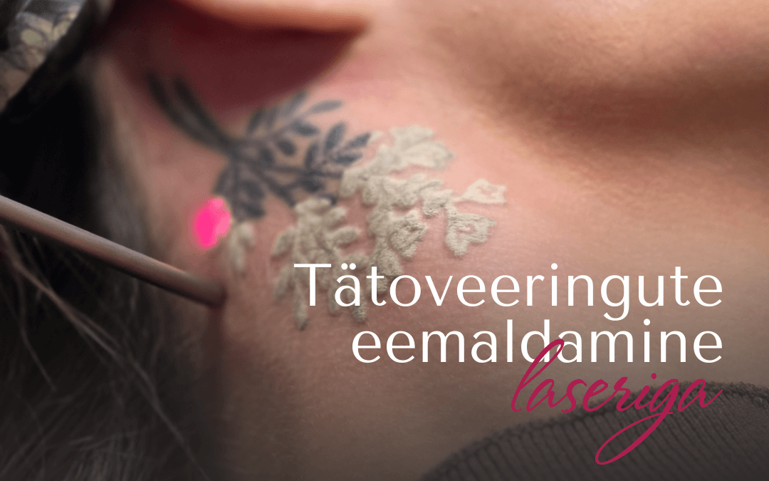 Tatoo_eemaldamine_uudis1