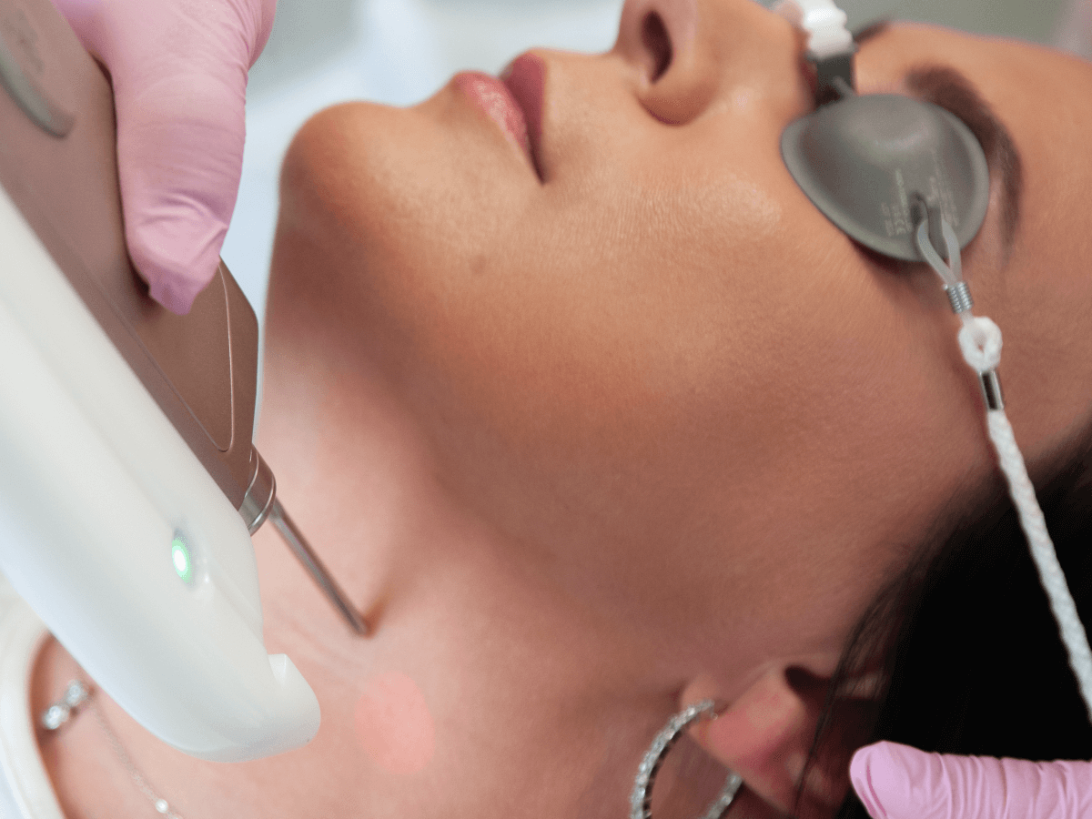 Papilloomide eemaldamine